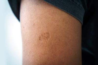 Por que a vacina BCG deixa marquinha no braço das pessoas?