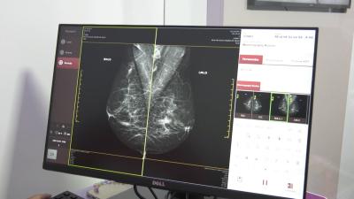 INCA estima 1.060 casos de câncer de mama no Maranhão em 2023